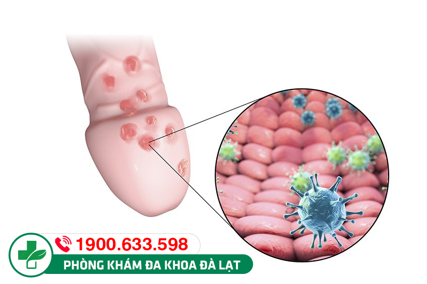 Mụn ở bao quy đầu: Nguyên nhân, biểu hiện và điều trị